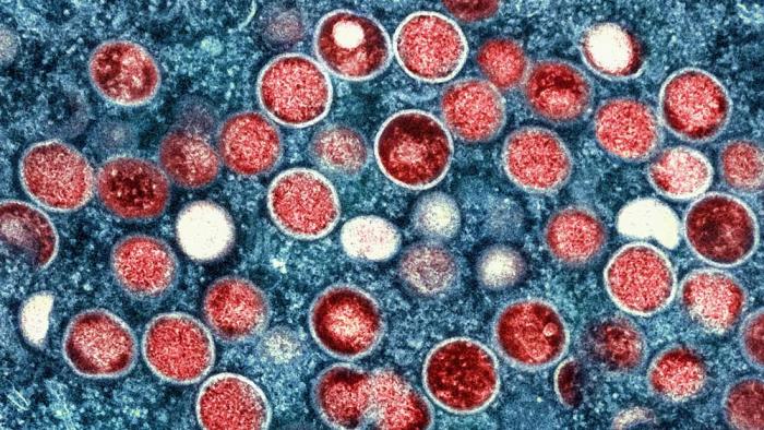 This undated image provided by the National Institute of Allergy and Infectious Diseases shows a colorized transmission electron micrograph of monkeypox particles (red) found within an infected cell (blue), cultured in the laboratory that was captured and color-enhanced at the NIAID Integrated Research Facility in Fort Detrick, Md.