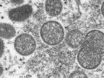 Portugal Finds 5 Monkeypox Cases in Men as Outbreak Spreads