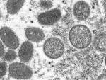 WHO: Nearly 200 Cases of Monkeypox in More than 20 Countries