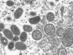 WHO Panel: Monkeypox Not a Global Emergency 'at this Stage'