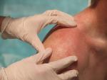 Monkeypox Cases Down in Europe, But Rising in U.S., Along with Children Being Diagnosed