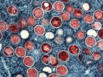 Mpox is Down, but US Cities could be at Risk for Summertime Outbreaks