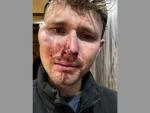 British Man Speaks Out After Brutal Homophobic Assault